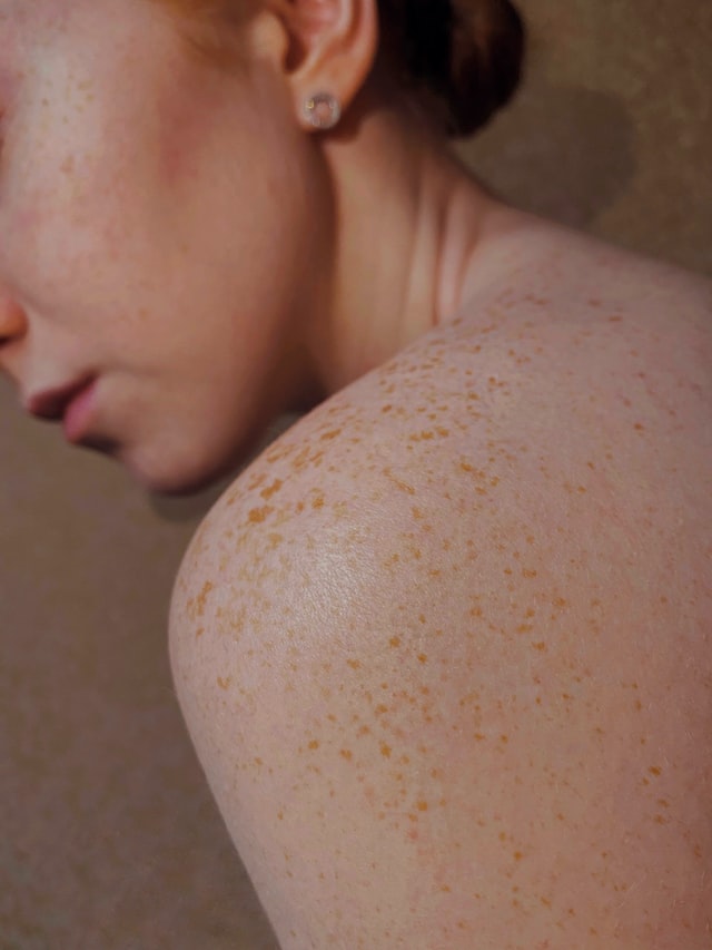 Red patches on your skin? Here’s how to treat them