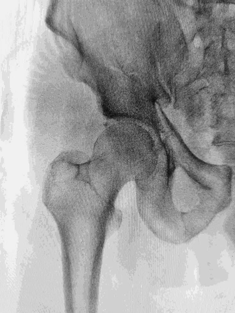 Chronic recurrent multifocal osteomyelitis