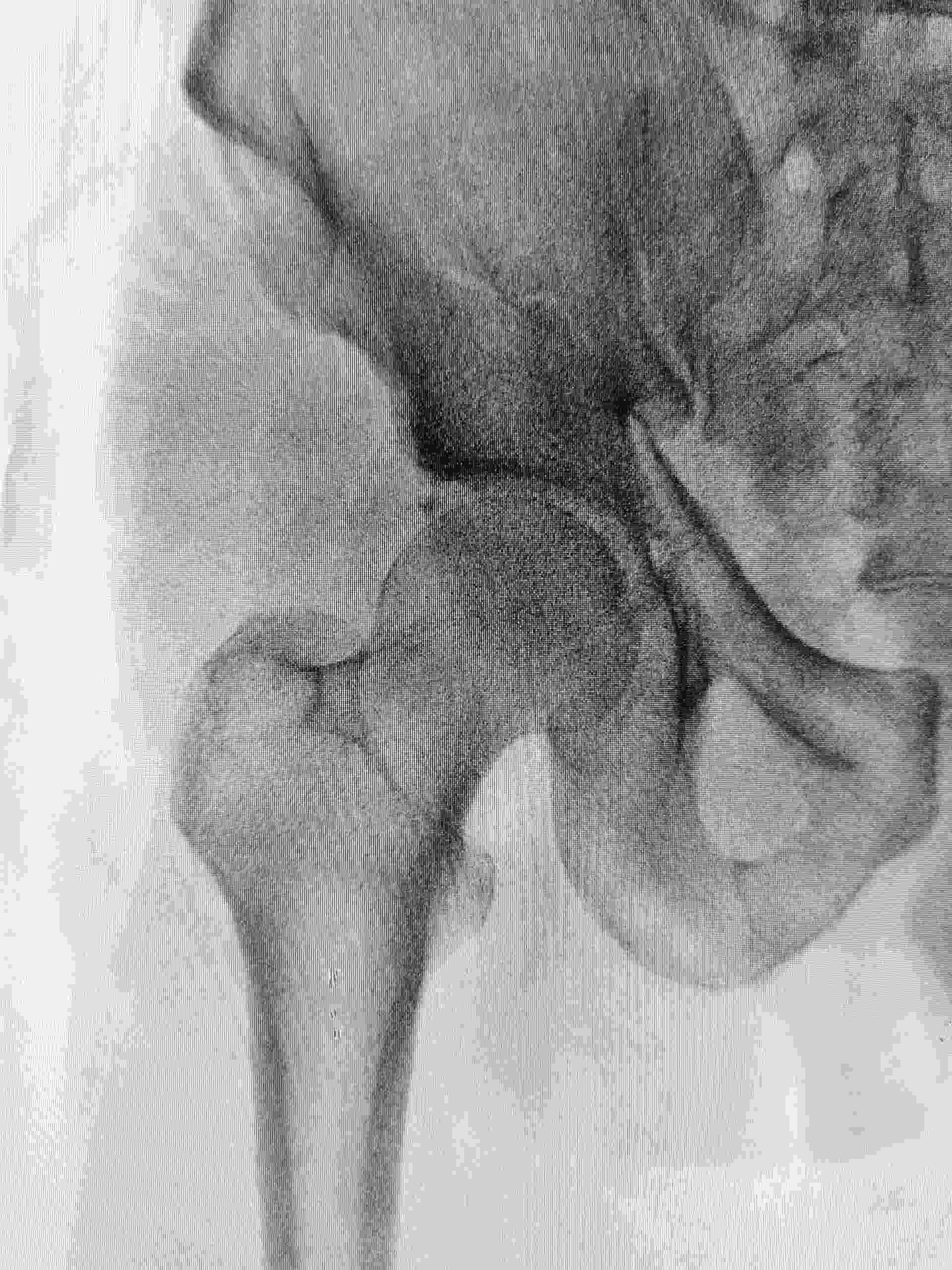 Chronic recurrent multifocal osteomyelitis